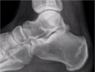 calcaneal fracture