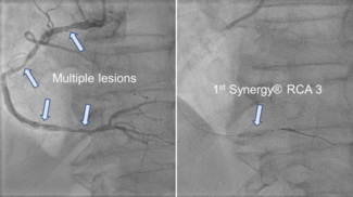 Rath Buddy Wire Technique Figure 1