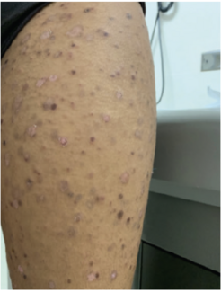 Dull pink, thin papules