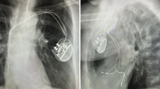 Verma Lead Extraction Figure 1 and 2