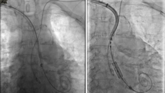 Waleed transcatheter aortic valve implantation Figure 2