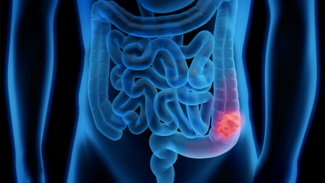 colorectal cancer