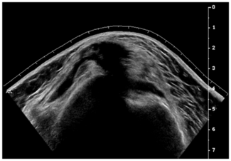 ultrasound