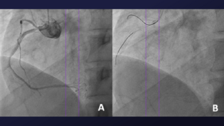 Wong Floating-Wire Technique Figure 1