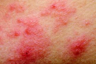 eczema