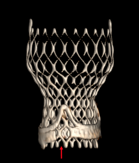 Garcia TVT Bioprosthetic valve fracture