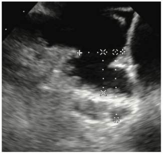 Manyam Left Atrial Appendage Figure 1