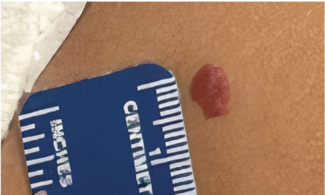 11 focal infantile hemangiomas