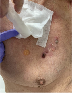 A cluster of multiple, tense bullae