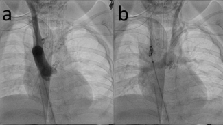 Seckeler Aorto-pulmonary Shunt Figure 1AB