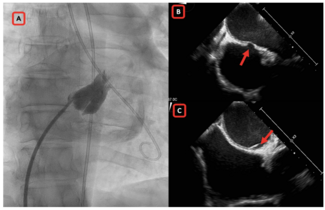 Velayutham Commissurotomy Figure 1