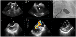 Cheuk Bong Intracardiac Echocardiography Figure 1