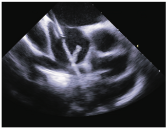 Guzmán-Olea Atrial Septal Defect Figure 1
