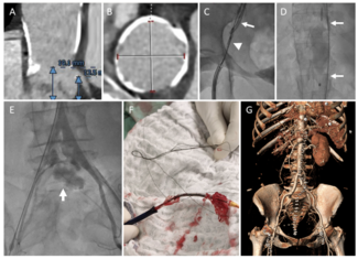 Jaffe TAVR Figure 1