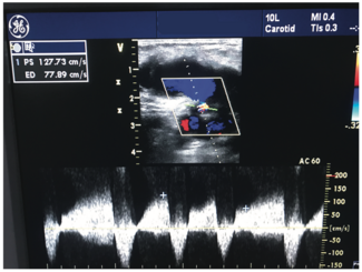 Khan Pseudoaneurysm Figure 3