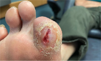 Using Medial Band Plantar Fasciotomy for Plantar Hallux Ulcers