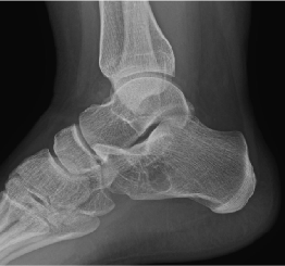 calcaneal bone cyst