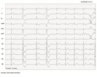 Saad Zero Fluoroscopy Ablation Figure 1
