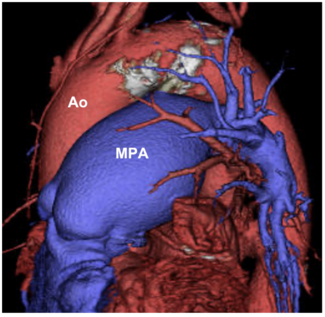 Takafuji Patent Ductus Arteriosus Figure 1
