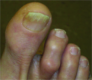 onychomycosis