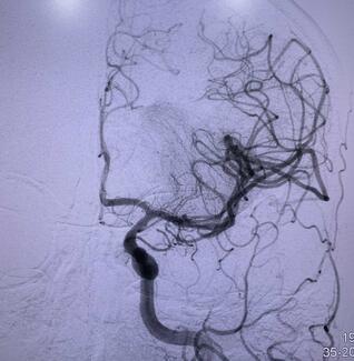 Figure 3. Digital subtraction angiography image of the left carotid injection showing occlusion of the left M1 middle cerebral artery.