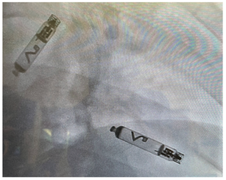 Lo Cardiac Pacing Figure 1