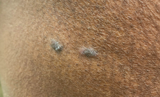 Lichen planus skin lesions.