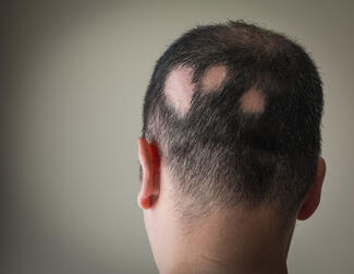 alopecia areata