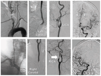 Minor Endovascular Therapy Figure 8A