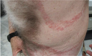 crusted, yellowish-brown papules