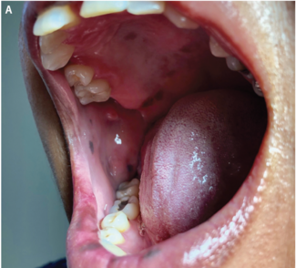 hyperpigmented macules on the hard palate and buccal mucosa