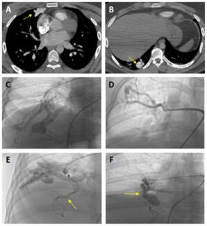 Figure. Thoracic computed tomographic angiography 