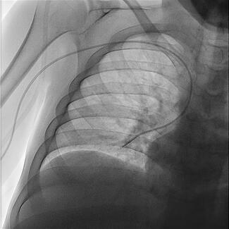 Figure 2. Right heart catheterization 