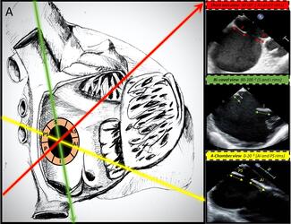 Figure 1. Transesophageal echocardiographic views demonstrating ASD rims. 