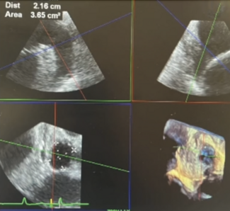 Mohan EPLD Watchman LAAO