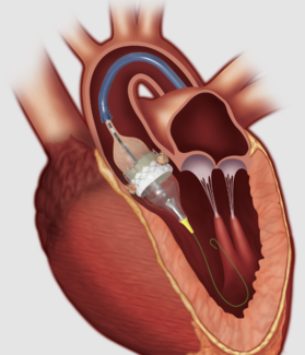 Sapien 3 Valve (Edwards)