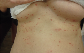 Numerous red-brown, waxy papules