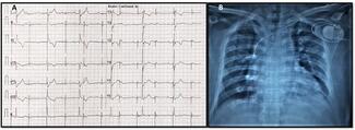 Figure 1. Electrocardiogram (ECG) and chest X-ray 