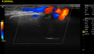 Figure 2. (A) Color Doppler showing the characteristic yin-yang flow within the arteriovenous fistula.