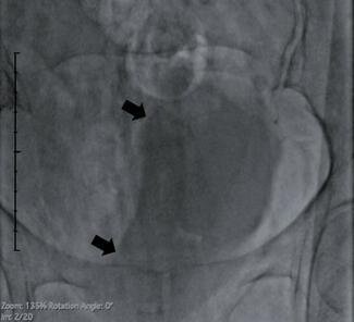 Figure. Bladder fluoroscopy 