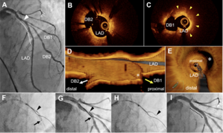 Figure. Restenosis of previous stent 