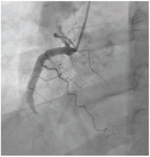 Pickard Renal Artery Stents Figure 1