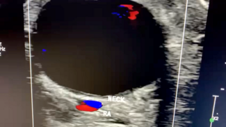 Video 1. Doppler ultrasound of pseudoaneurysm