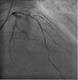 Figure 1. Wiring of angulated and diseased diagonal branch 