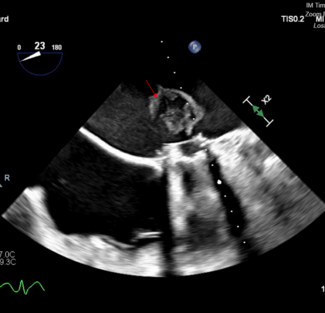 Figure 2. Transesophageal echocardiogram 