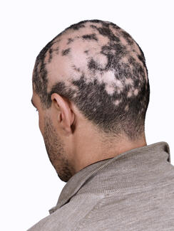 alopecia areata