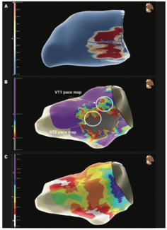 Barbhaiya Ventricular Tachycardia Figure 1