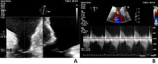 Figure 1. Preprocedural transesophageal echocardiogram 