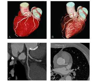 Figure 4. Coronary CT angiography