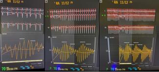 Figure.  Right atrial pressure Torsades de pointes